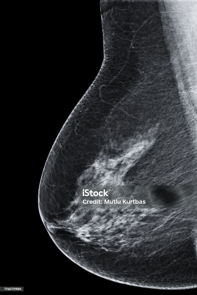 Рак молочной железы Маммограмма - Стоковые фото Маммограмма роялти-фри