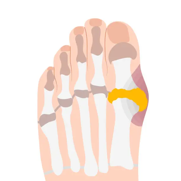 Vector illustration of Gout is a type of inflammatory arthritis that causes pain and swelling in your joints, usually as flares that last for a week or two, and then resolve. Gout flares often begin in your big toe or a low