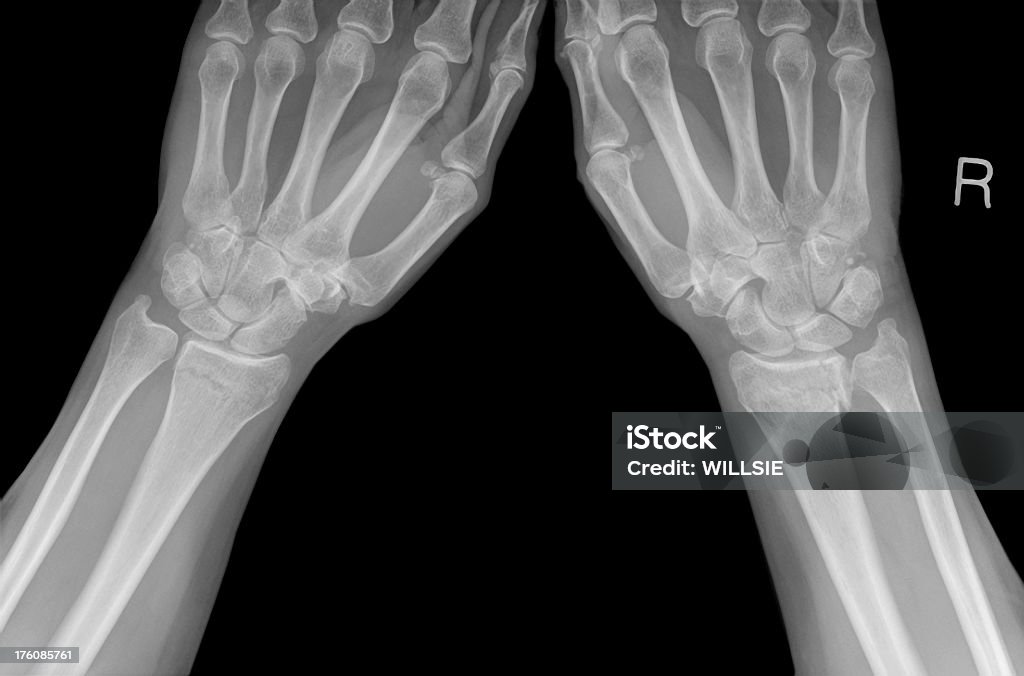 Digitale Handgelenk Röntgenapparate von colles Brüche in postmenopausal Osteoporose - Lizenzfrei Handgelenk Stock-Foto