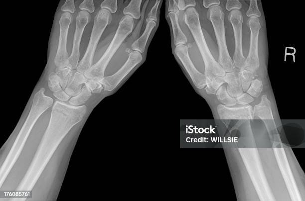 Digitale Handgelenk Röntgenapparate Von Colles Brüche In Postmenopausal Osteoporose Stockfoto und mehr Bilder von Handgelenk