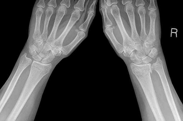 디지탈 손목 X선 촬영을 colles 골절이 폐경 후 골다공증으로. 스톡 사진