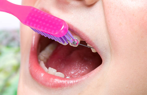 人の女の子ブラッシング新しい歯科歯列矯正器 - misalignment ストックフォトと画像