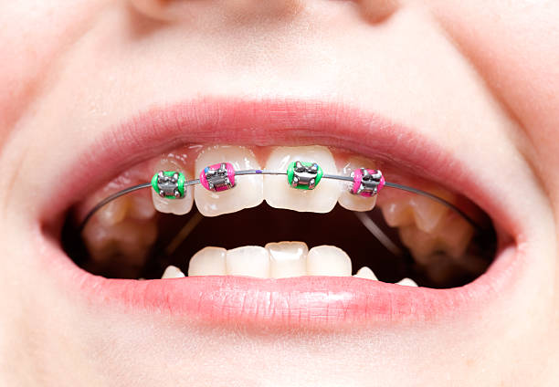 kind mädchen neuen dental zahnspange - fehlbiss stock-fotos und bilder