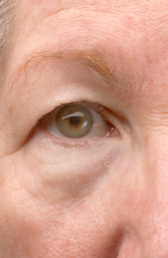 The right  green eye of a woman showing a drooping eye lid.
