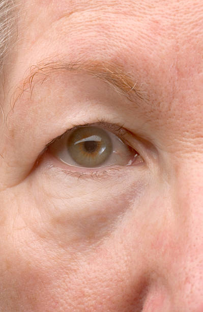 Woman's droopy eyelid stock photo
