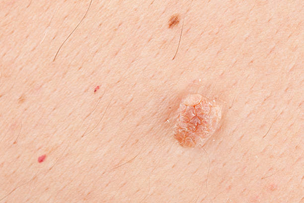Skin Wart "Macro shot of a skin wart that should be inspected by a dermatologist. Cropped from a 21MP photo. (Canon 5D Mark II, Adobe RGB)" wart stock pictures, royalty-free photos & images