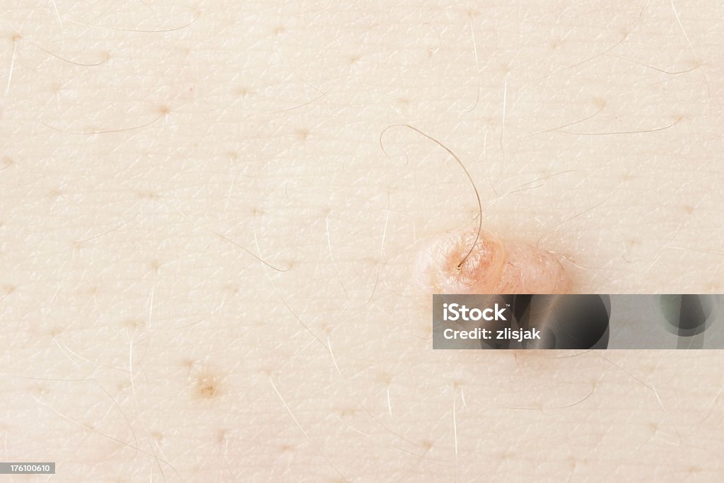Skin Wart With A Hair Stock Photo - Download Image Now - Beauty, Benign  Tumor, Bright - iStock