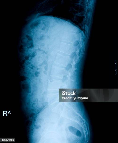Xray Image Lumbosacralrückenwirbel Stockfoto und mehr Bilder von Anatomie - Anatomie, Brustbereich, Daten