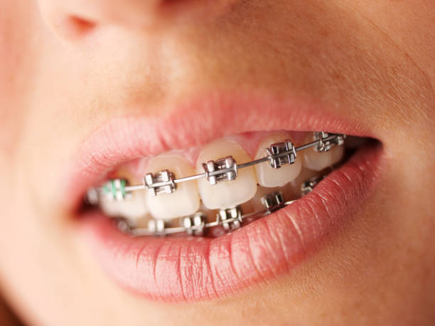 istock Month and Dental Brace 176114378