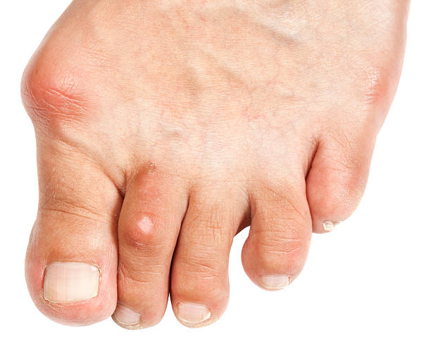 deformato piede-alluce valgo - human foot bunion pain human toe foto e immagini stock