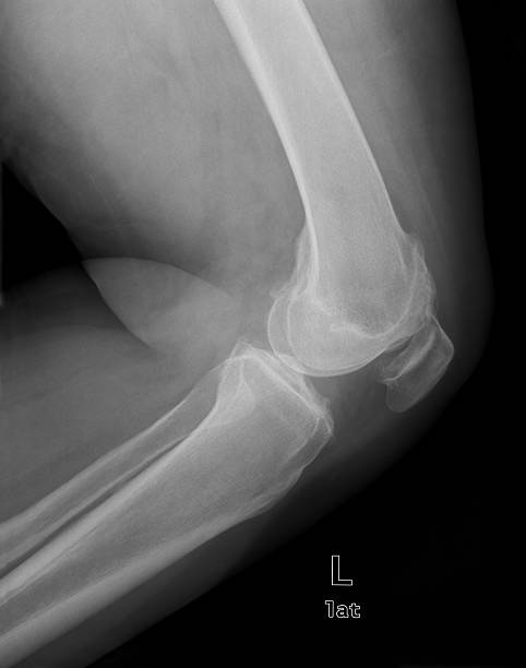 genou x-ray image - x ray human knee orthopedic equipment human bone photos et images de collection