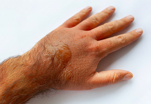 A man's hand burned with boiling water. On it there are redness and blisters.