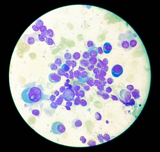 istock Microscopic view of bone marrow slide showing Multiple myeloma, also known as myeloma, is a type of bone marrow cancer. 1761913138