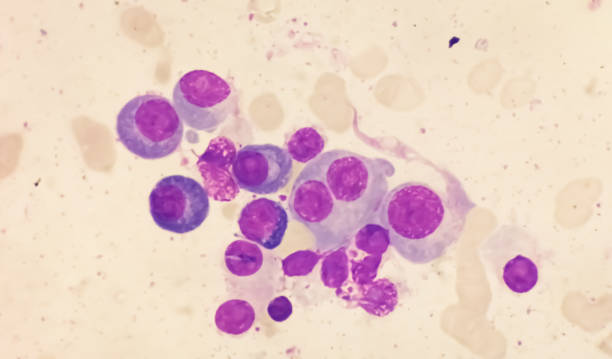 istock Microscopic view of bone marrow slide showing Multiple myeloma, also known as myeloma, is a type of bone marrow cancer. 1761913154