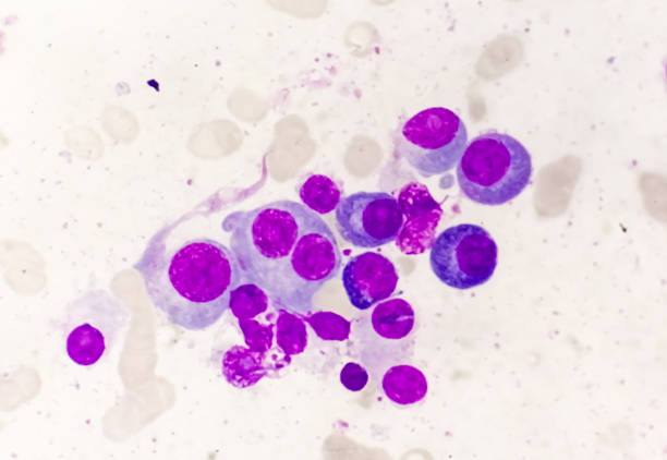 istock Microscopic view of bone marrow slide showing Multiple myeloma, also known as myeloma, is a type of bone marrow cancer. 1761913672
