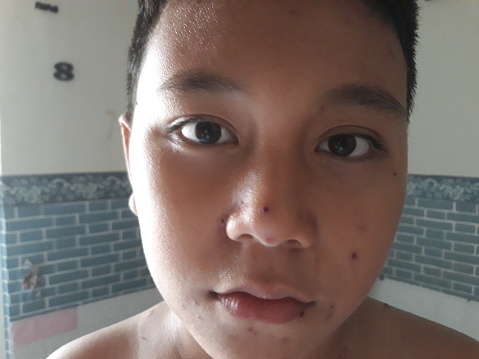 close up portrait of elementary age boy itching due to chickenpox. Wellness home care treatment chickenpox because varicella zoster virus