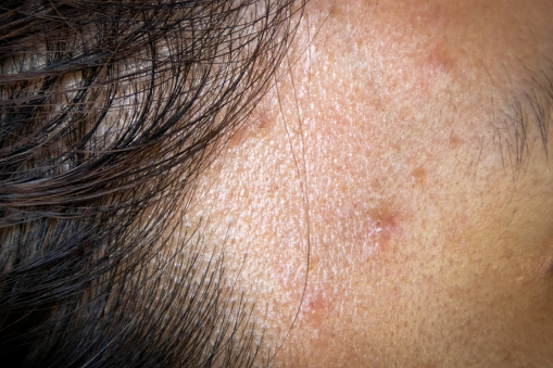 Close-up view of a pimple on a young woman's facial skin that forms between the hair and face.