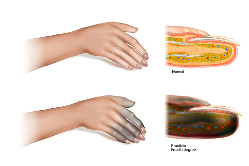 Frostbite Fourth degree. Skin injury that occurs when exposed to extreme low temperatures, causing the freezing of the skin or other tissues.