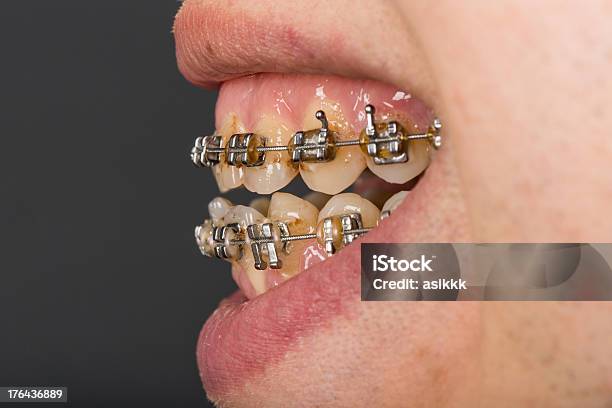 Dental Wire Stock Photo - Download Image Now - Adult, Beauty, Bent