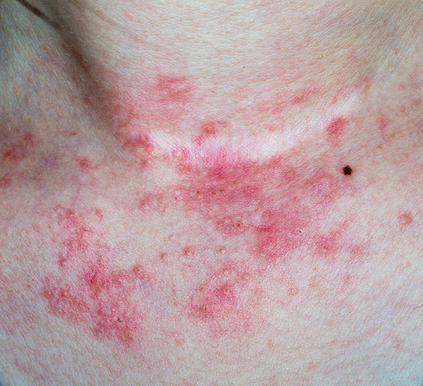 eczema haut am hals - toxicodermatitis stock-fotos und bilder