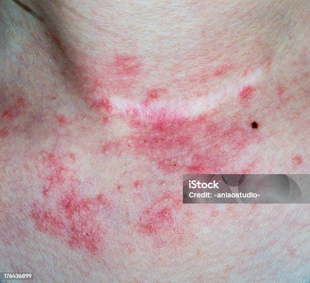 Eczema Pelle Sul Collo - Fotografie stock e altre immagini di Dermatite tossica - Dermatite tossica, Eczema, Eczema atopico