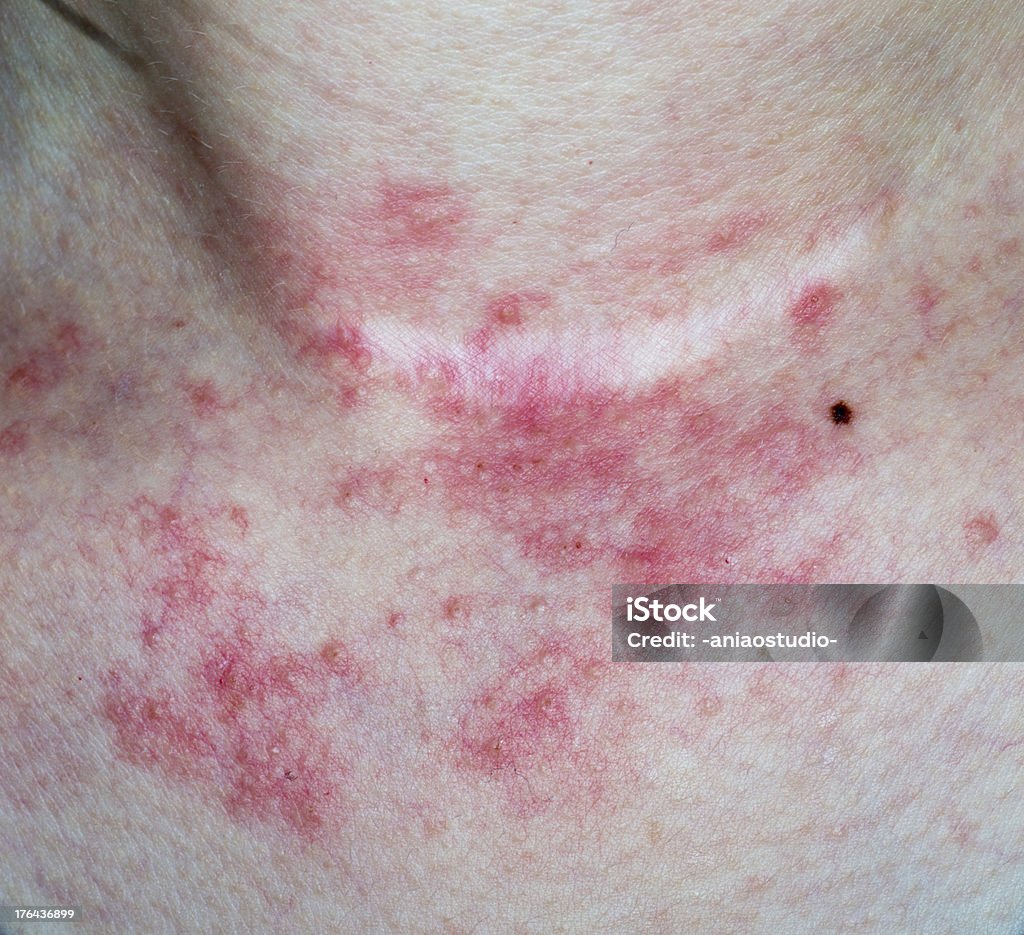 eczema, pele do pescoço - Royalty-free Dermatite Tóxica Foto de stock