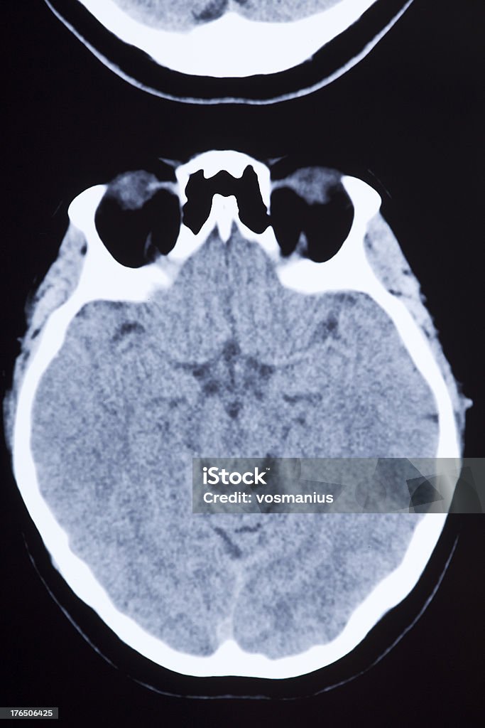 Medizinische MRI Bild mit Gehirn und Schädel - Lizenzfrei Aneurysma Stock-Foto
