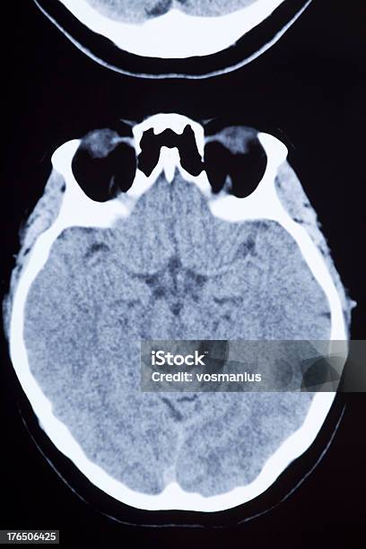 Medizinische Mri Bild Mit Gehirn Und Schädel Stockfoto und mehr Bilder von Aneurysma - Aneurysma, Computertomogramm, Gehirn