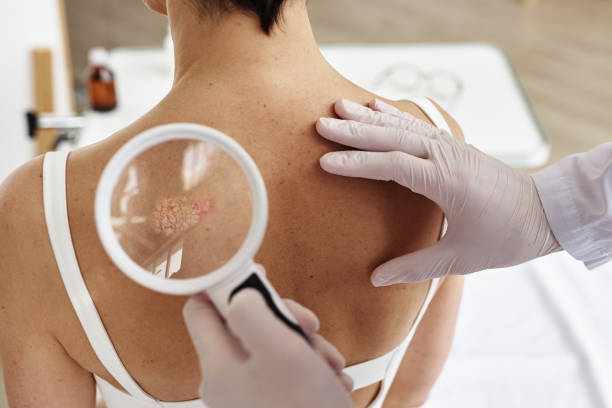 Close up of doctor holding magnifying glass examining back of female patient Close up of doctor holding magnifying glass while examining back of female patient with rash spots in dermatology clinic, copy space photo psoriasis stock pictures, royalty-free photos & images