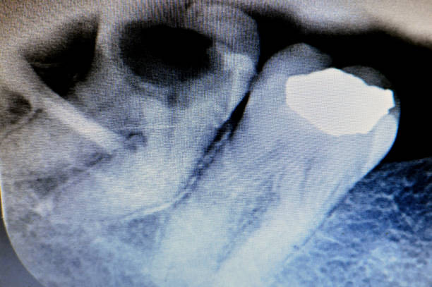istock X ray on wisdom 8th lower right tooth with a teeth decay, after exposed nerve and severe pain, swelling and inflammation, Wisdom teeth are the molars back teeth, come through last and furthest back 1765488834