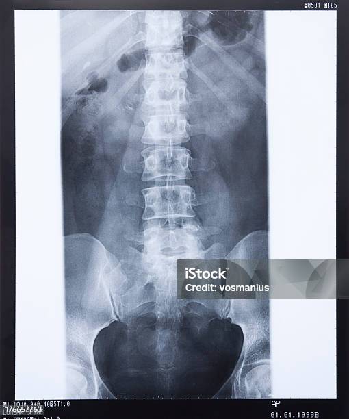 Imagem De Raios X - Fotografias de stock e mais imagens de Branco - Branco, Ceco, Coluna vertebral humana