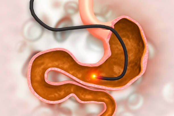 istock Human Stomach with endoscope and close-up view of bacterium Helicobacter pylori which causes ulcers, stomach ulcer or gastric ulcer, 3d illustration 1766996841