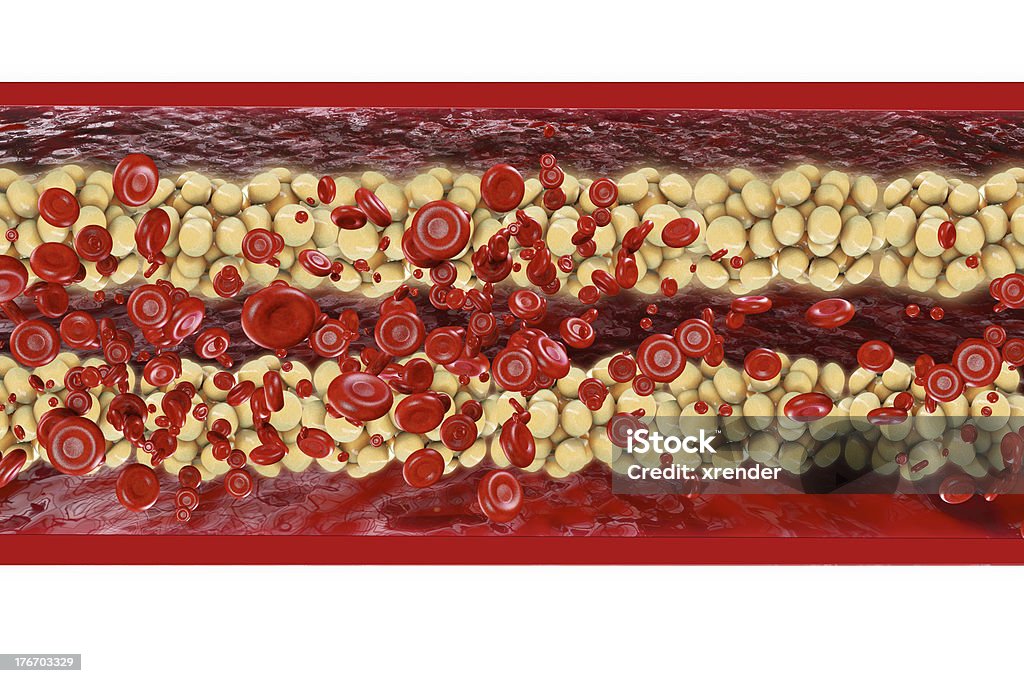 Cholesterol - 3d rendered illustration Calcification Stock Photo
