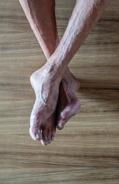 Both feet of an old man that was naturally rough