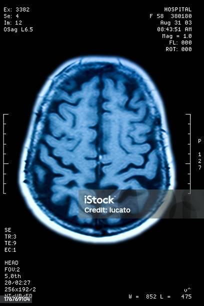 Resonancia De Cerebro Foto de stock y más banco de imágenes de Imagen de resonancia magnética - Imagen de resonancia magnética, Escáner IRM, Fondo negro