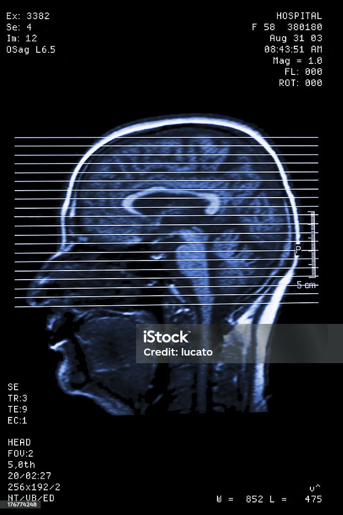 헤드 레조낭스 - 로열티 프리 MRI 스캐너 스톡 사진