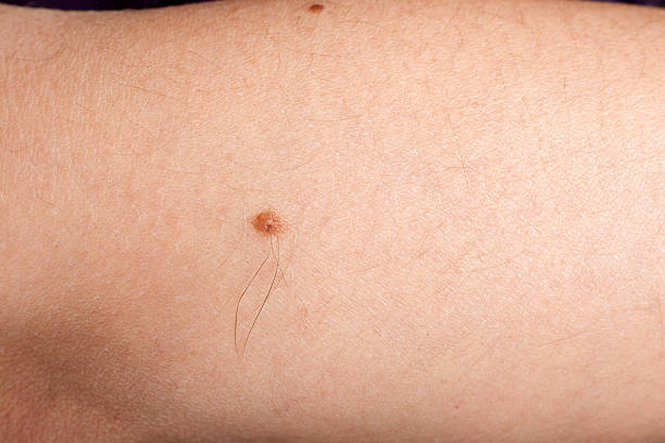 melanoma on woman arm stock photo