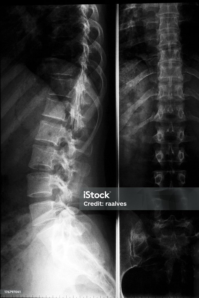 Raios-X de coluna vertebral lombar, clássica radiologia - Royalty-free Anatomia Foto de stock