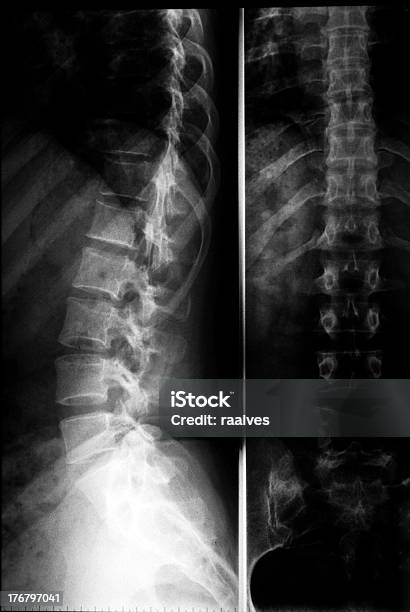 Raiosx De Coluna Vertebral Lombar Clássica Radiologia - Fotografias de stock e mais imagens de Anatomia