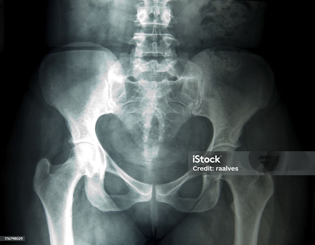 x-ray de mujer pelvis - Foto de stock de Imagen de rayos X libre de derechos