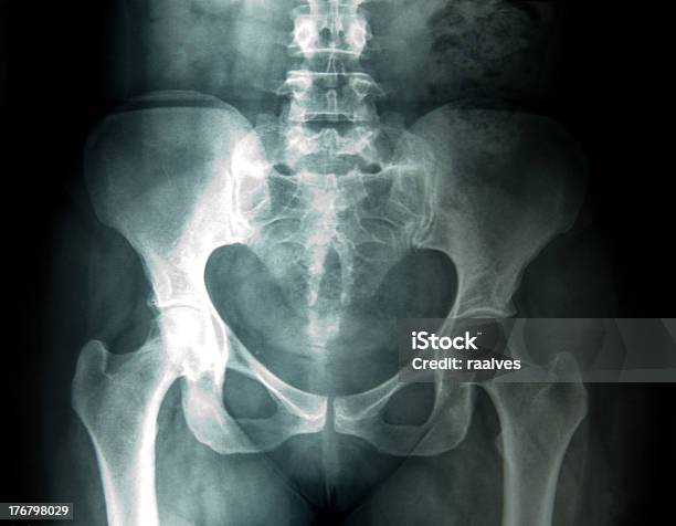 Xray De Mujer Pelvis Foto de stock y más banco de imágenes de Imagen de rayos X - Imagen de rayos X, Zona Genital, Fémina