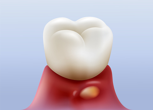 Gingivitis, swollen and purulent or inflammation of the tooth roots For dental clinics and treatments. Realistic vector illustration file.