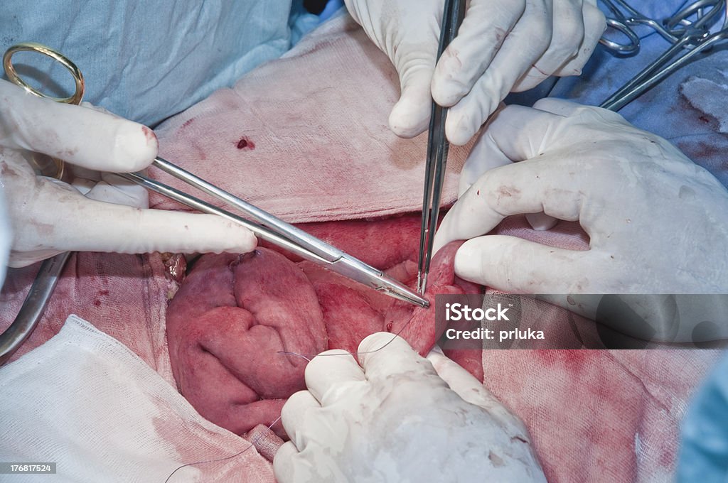 Хирургическое вмешательство на брюшной полости - Стоковые фото Больница роялти-фри
