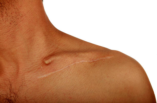 Man's shoulder with a scar from operation Man's shoulder with a scar from operation isolated clavicle stock pictures, royalty-free photos & images