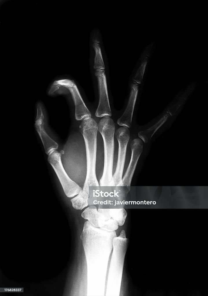 Mão radiografia torácica - Royalty-free Acidente - Conceito Foto de stock