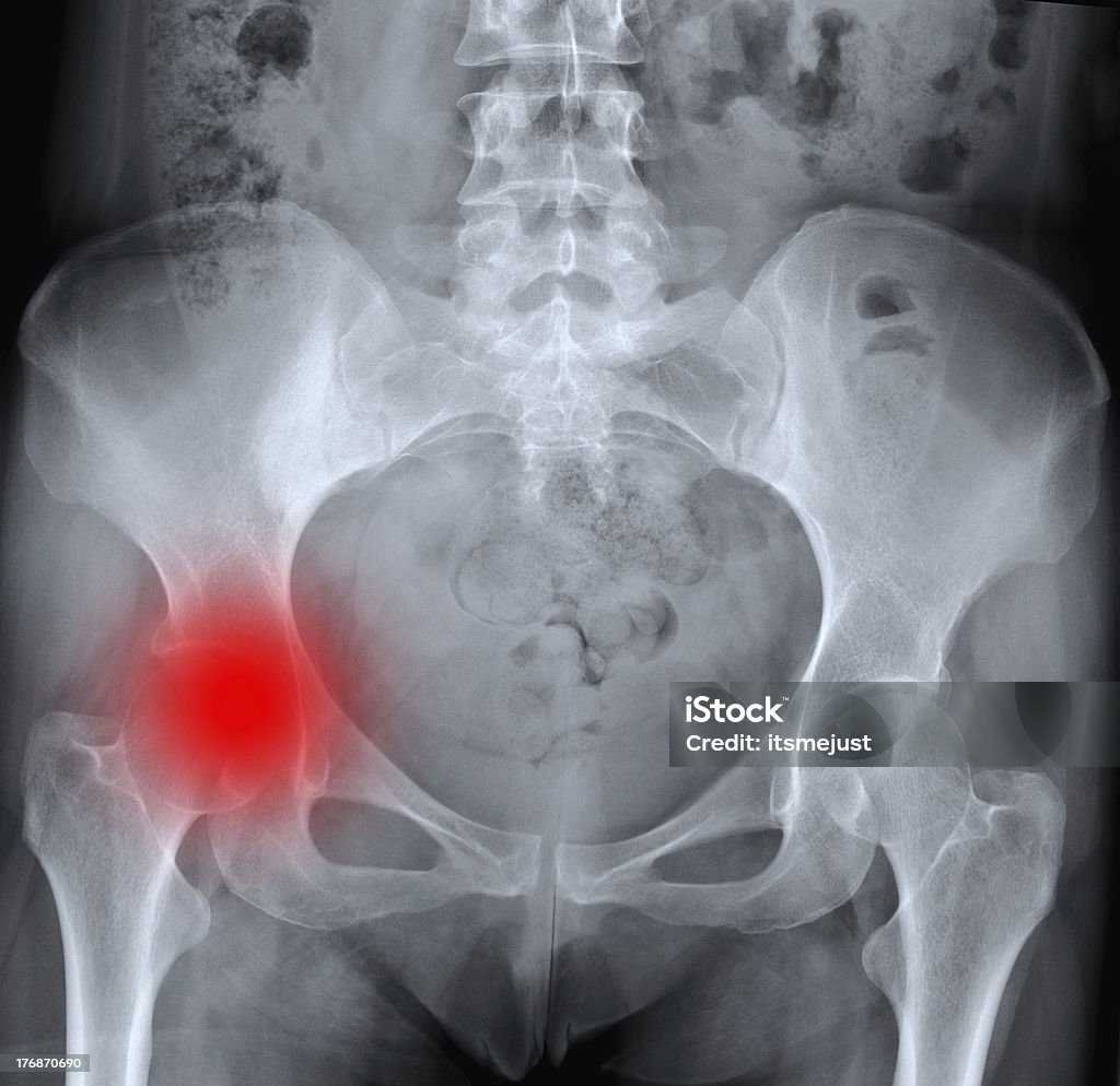X-레이 of 고통스러운 엉덩관절 - 로열티 프리 골절 스톡 사진