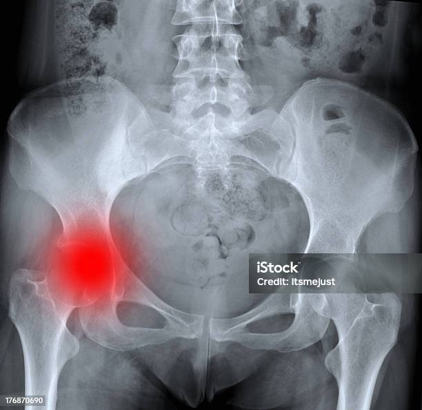 X레이 Of 고통스러운 엉덩관절 골절에 대한 스톡 사진 및 기타 이미지 - 골절, 엉덩관절, X-레이