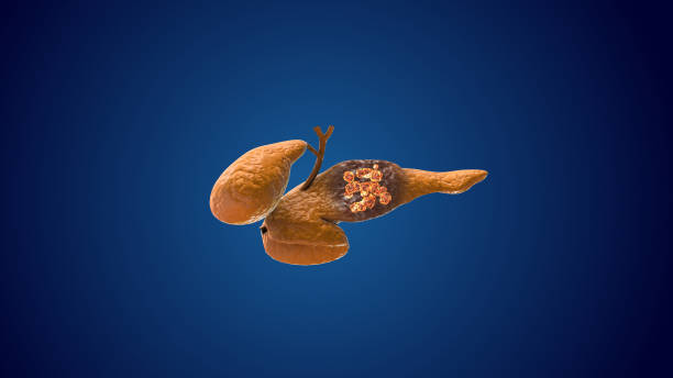 daño pancreático y crecimiento de células cancerosas - conducto pancreático fotos fotografías e imágenes de stock