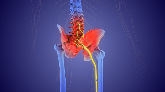 Pain radiating along the sciatic nerve, which runs down one or both legs from the lower back.
It's usually caused when a herniated disc or bone spur in the spine presses on the nerve.
Pain originates in the spine and radiates down the back of the leg. Sciatica typically affects only one side of the body. Medication for pain and physiotherapy are common treatments.