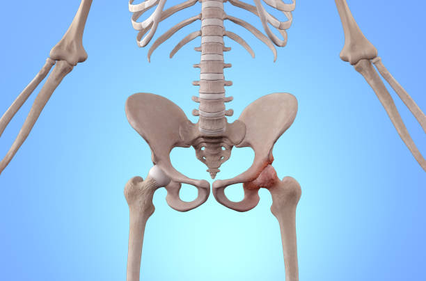 istock Osteoarthritis femur head pain 1769187757
